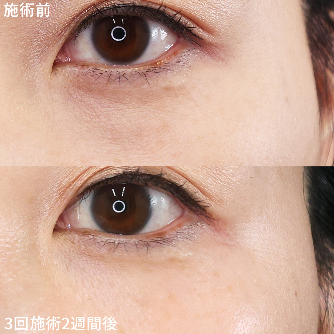 注射・プチ整形：その他の症例写真 施術前後 