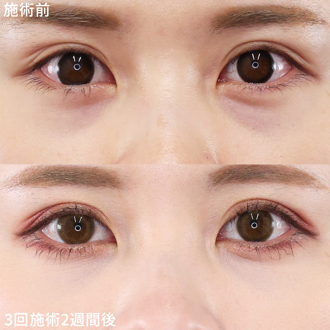 スネコス注射で《青クマ》すっきり！