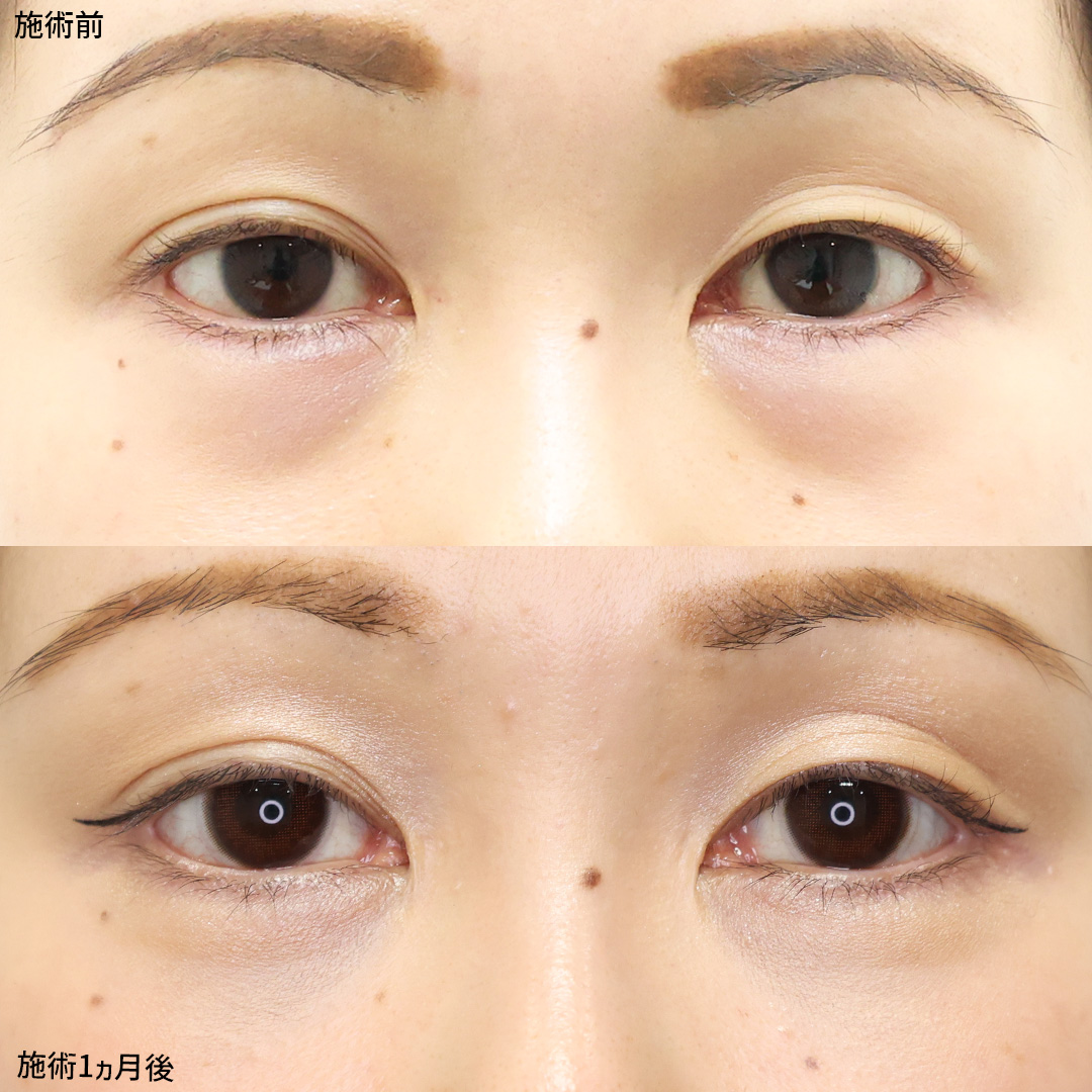 【クマ取り施術】幅広い年代から人気！