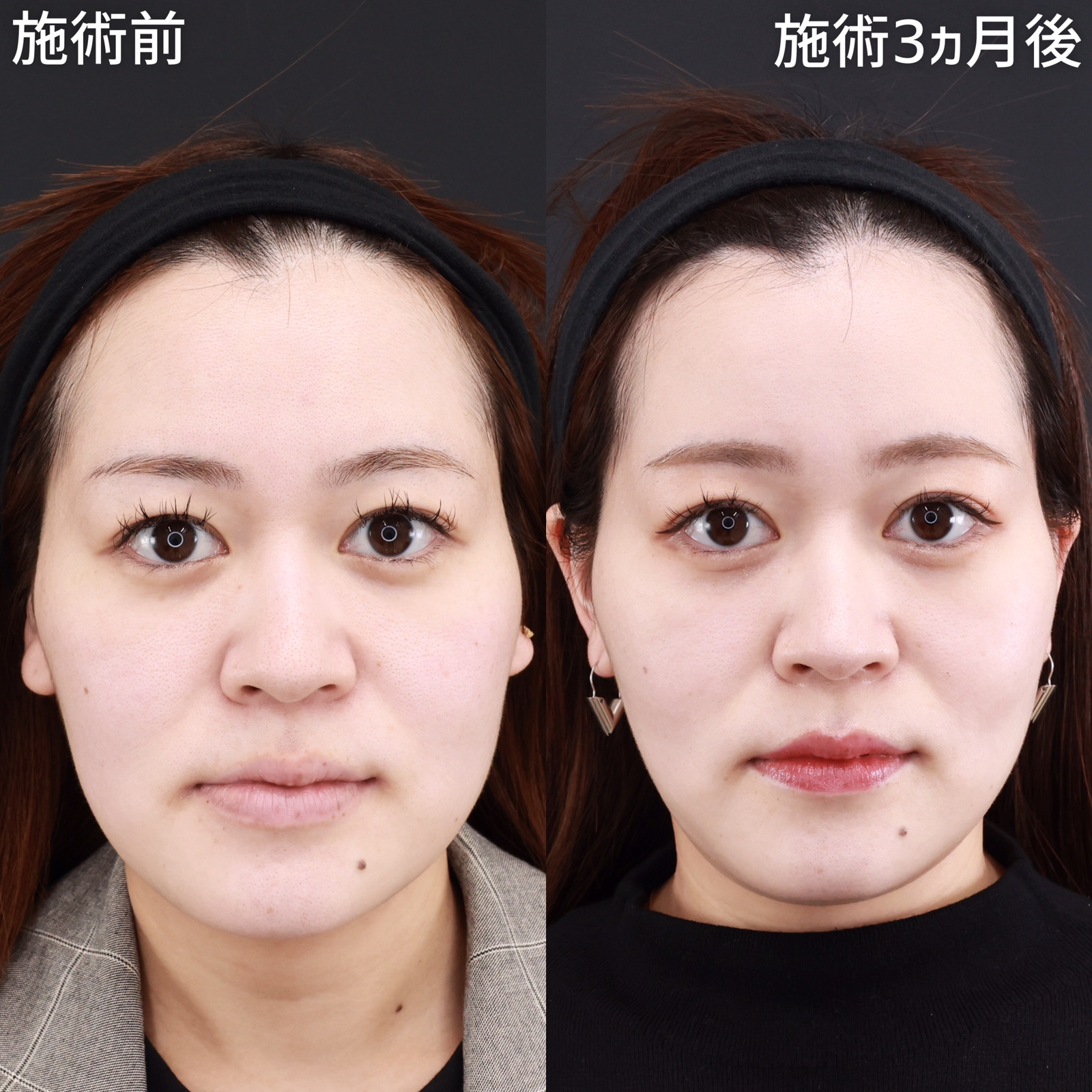 【糸リフト極&amp;ジョールファット除去】口元のもたつきを改善しスッキリと