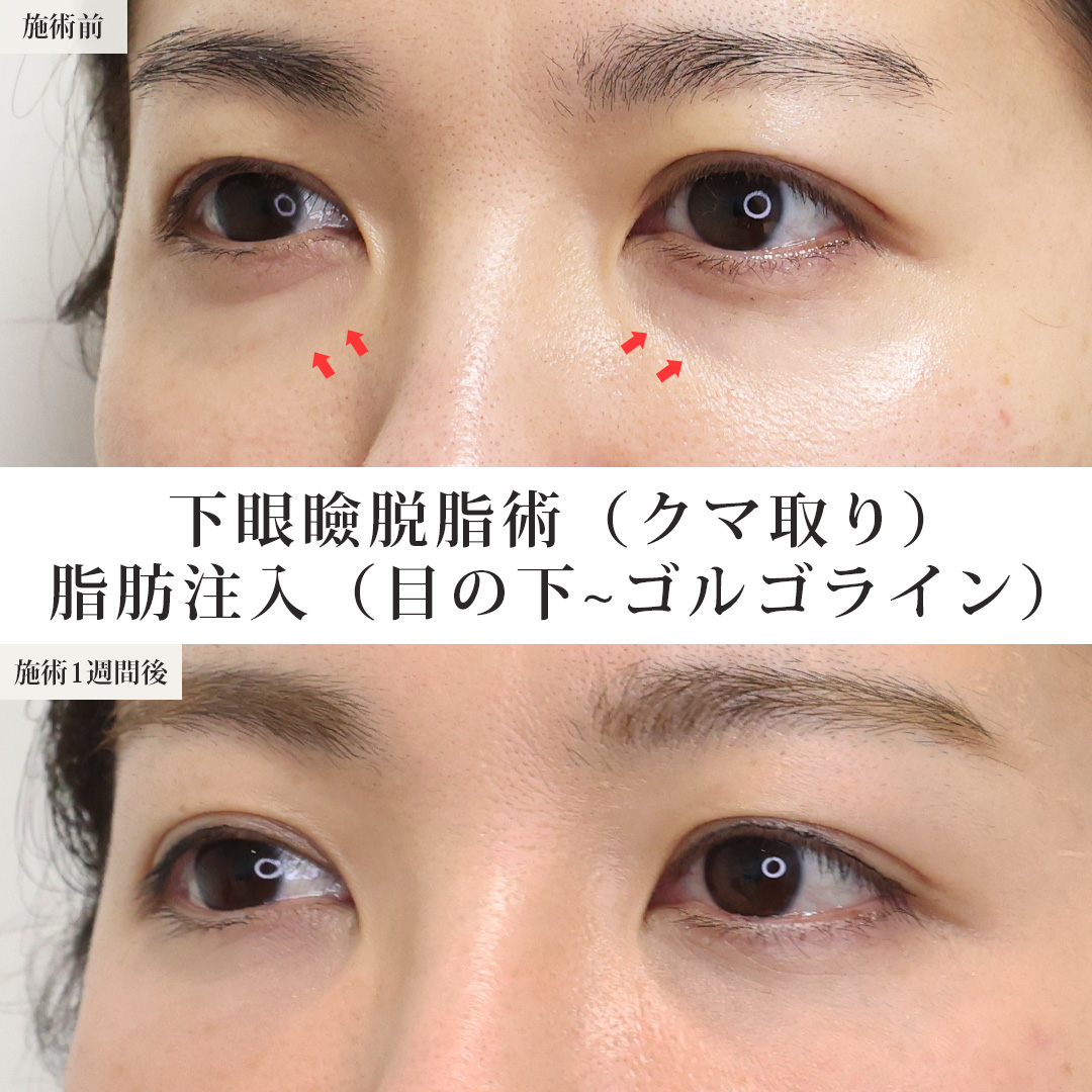 下眼瞼脱脂術（目の下のたるみ取り・目の下の脂肪ふくらみ取り）の症例写真 施術前後 1週間