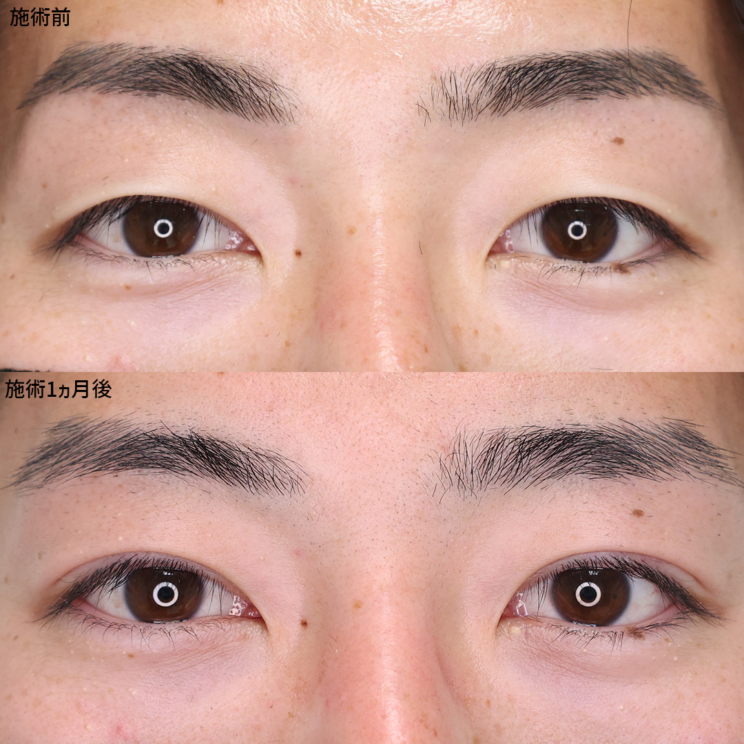 【クイックコスメリング】男性のナチュラル二重施術