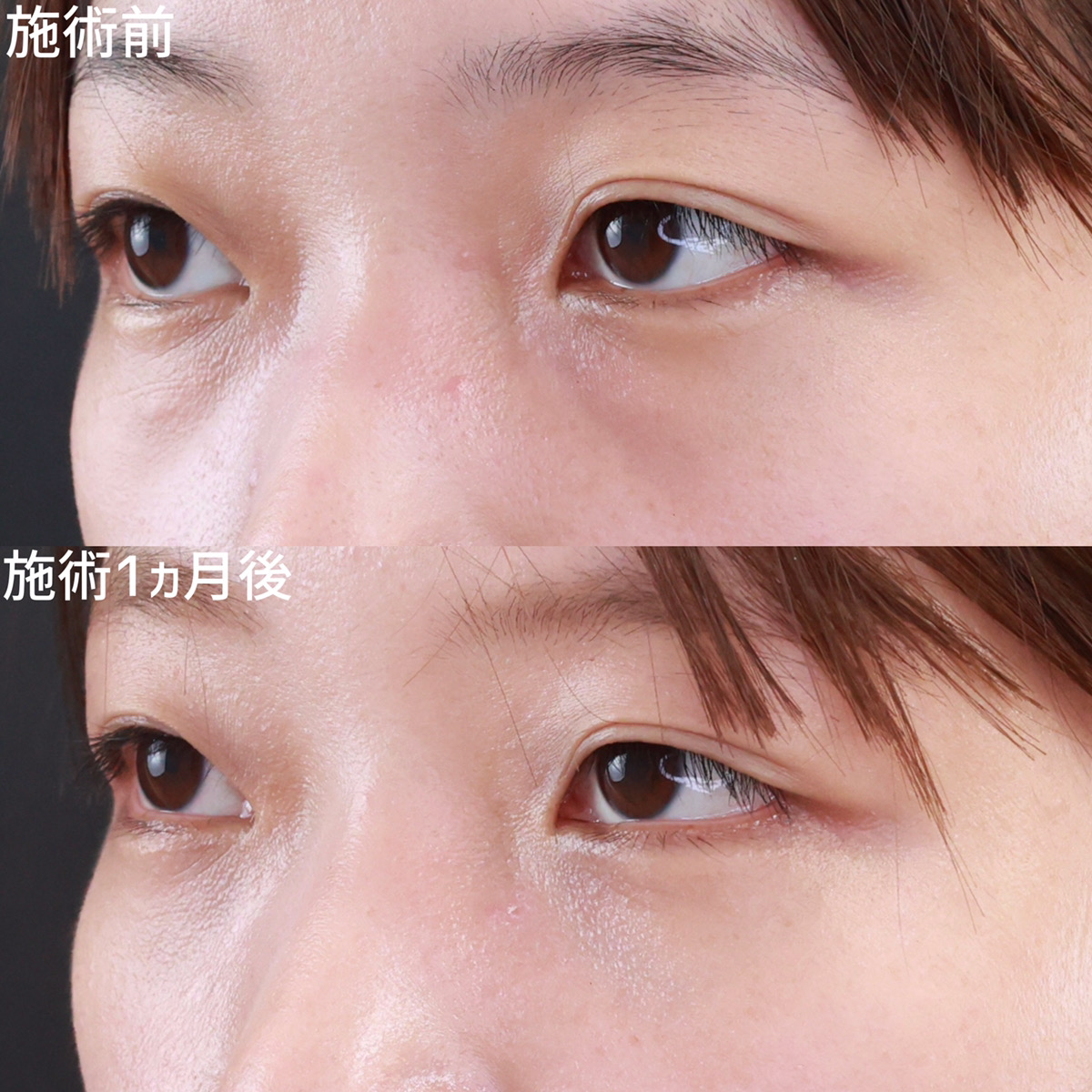 下眼瞼脱脂術(目の下のたるみ取り・目の下の脂肪ふくらみ取り)の症例写真 施術前後