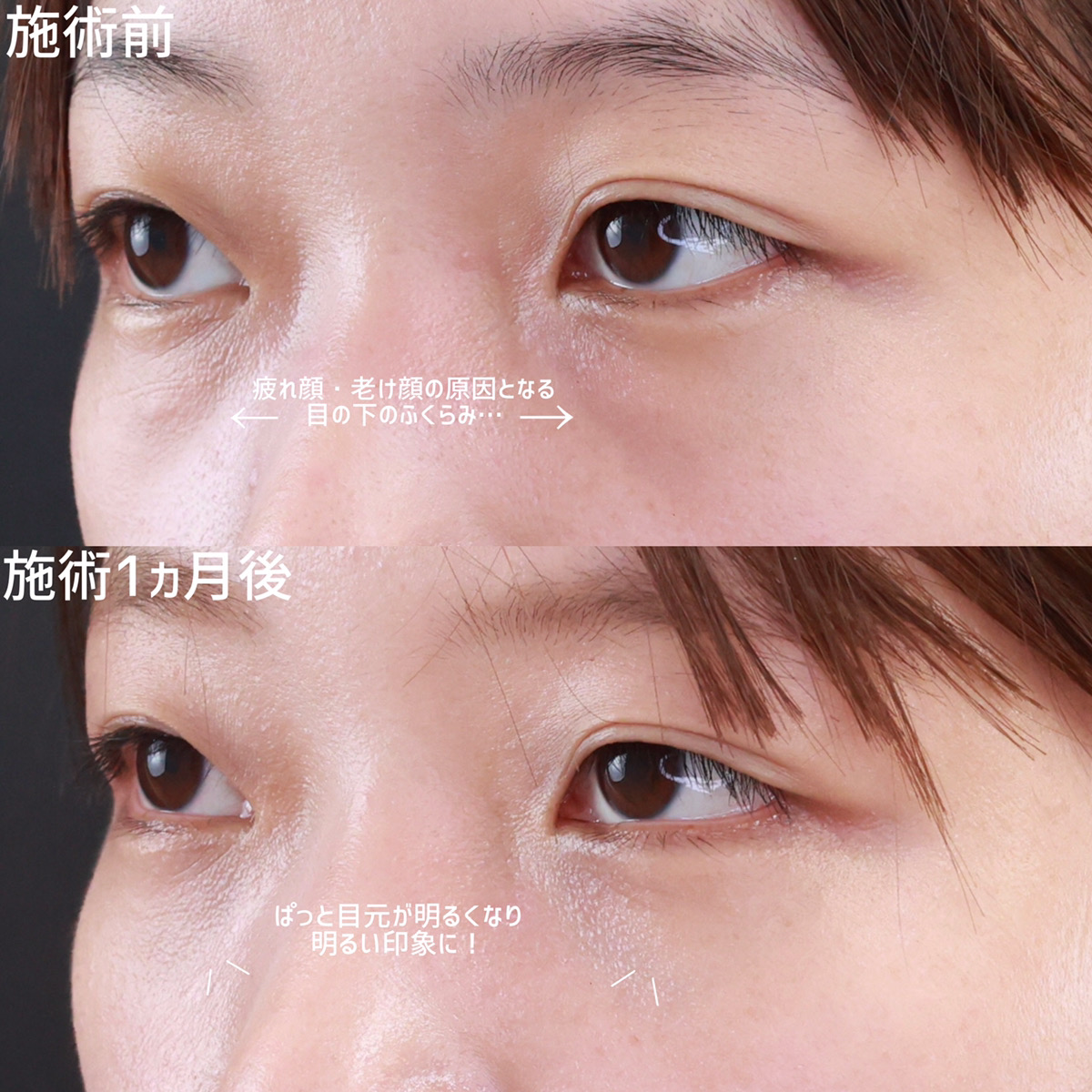 下眼瞼脱脂術(目の下のたるみ取り・目の下の脂肪ふくらみ取り)の症例写真 施術前後