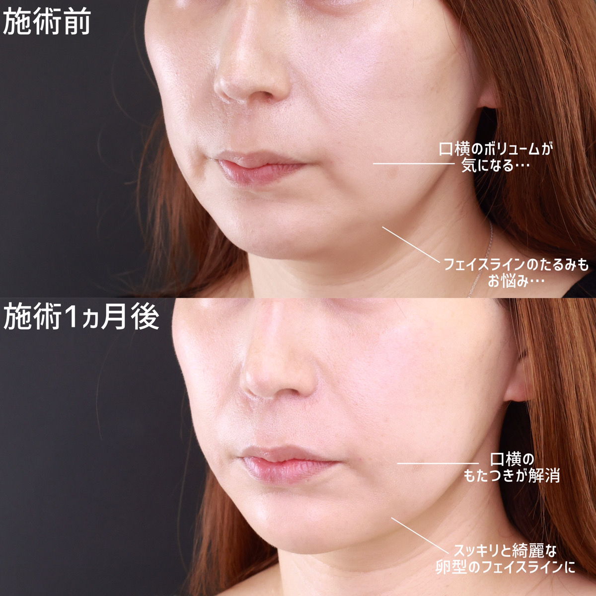 小顔整形｜パーフェクトフェイスライン/TAC式 ツヤ肌コラーゲンリフト®/ジョールファット除去の症例写真 施術前後 