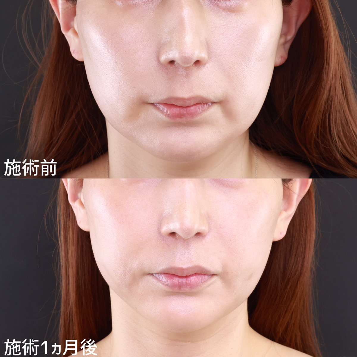 小顔整形｜パーフェクトフェイスライン/TAC式 ツヤ肌コラーゲンリフト®/ジョールファット除去の症例写真 施術前後 