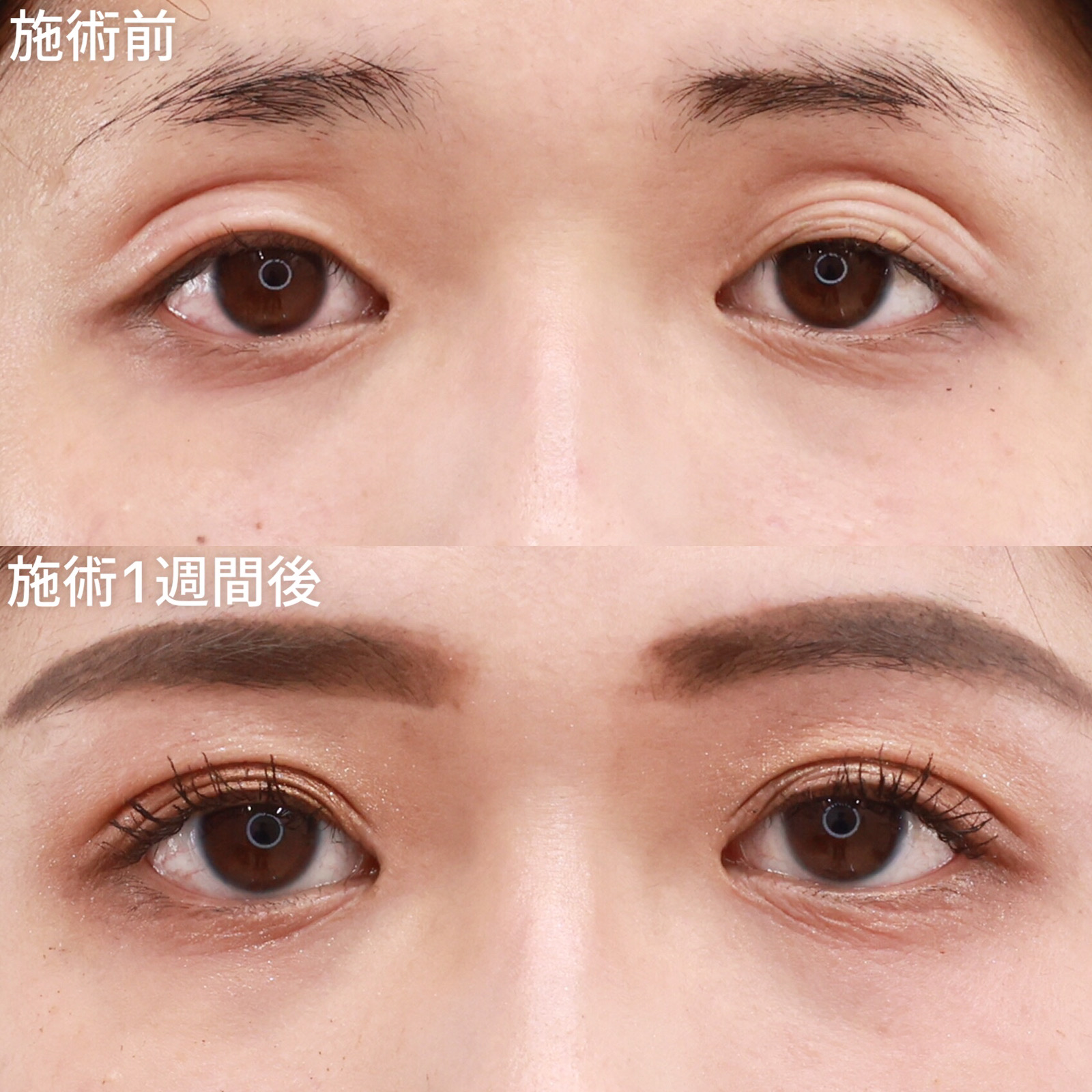 眼瞼下垂 20代の症例写真・画像・ビフォーアフター｜美容整形