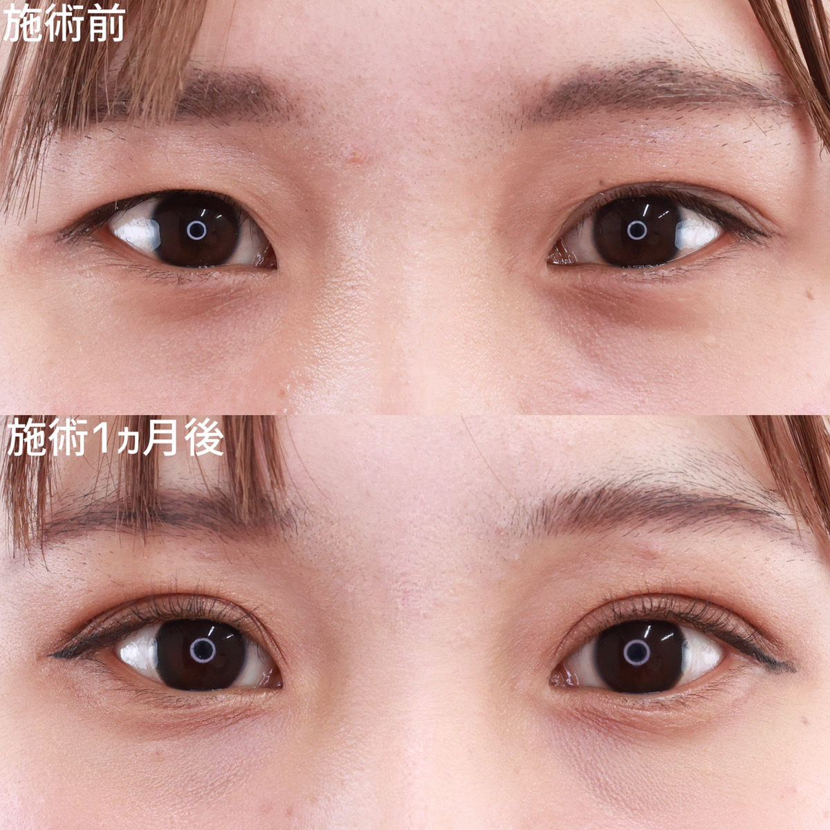 二重埋没法/目元:その他の症例写真 施術前後