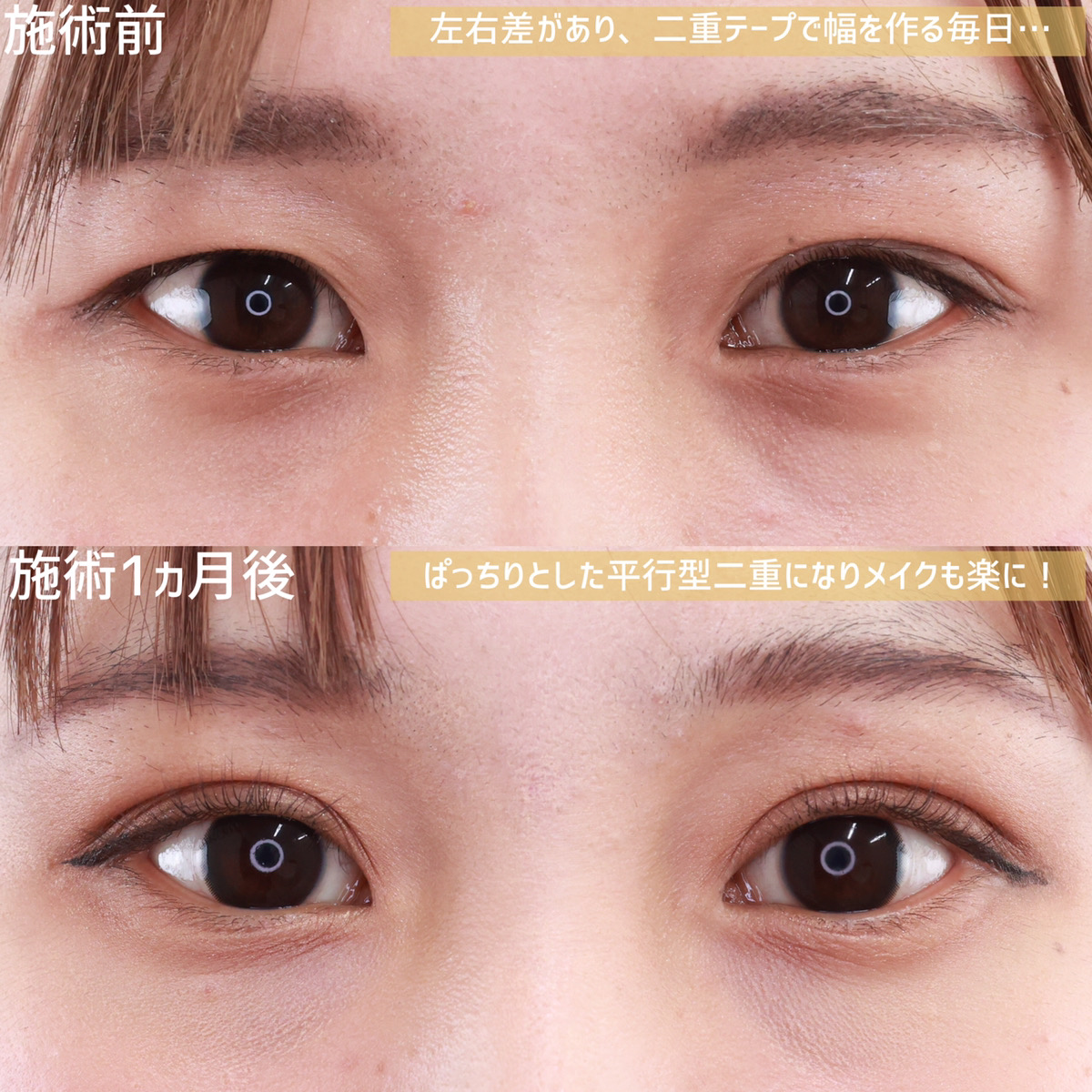 二重埋没法/目元:その他の症例写真 施術前後