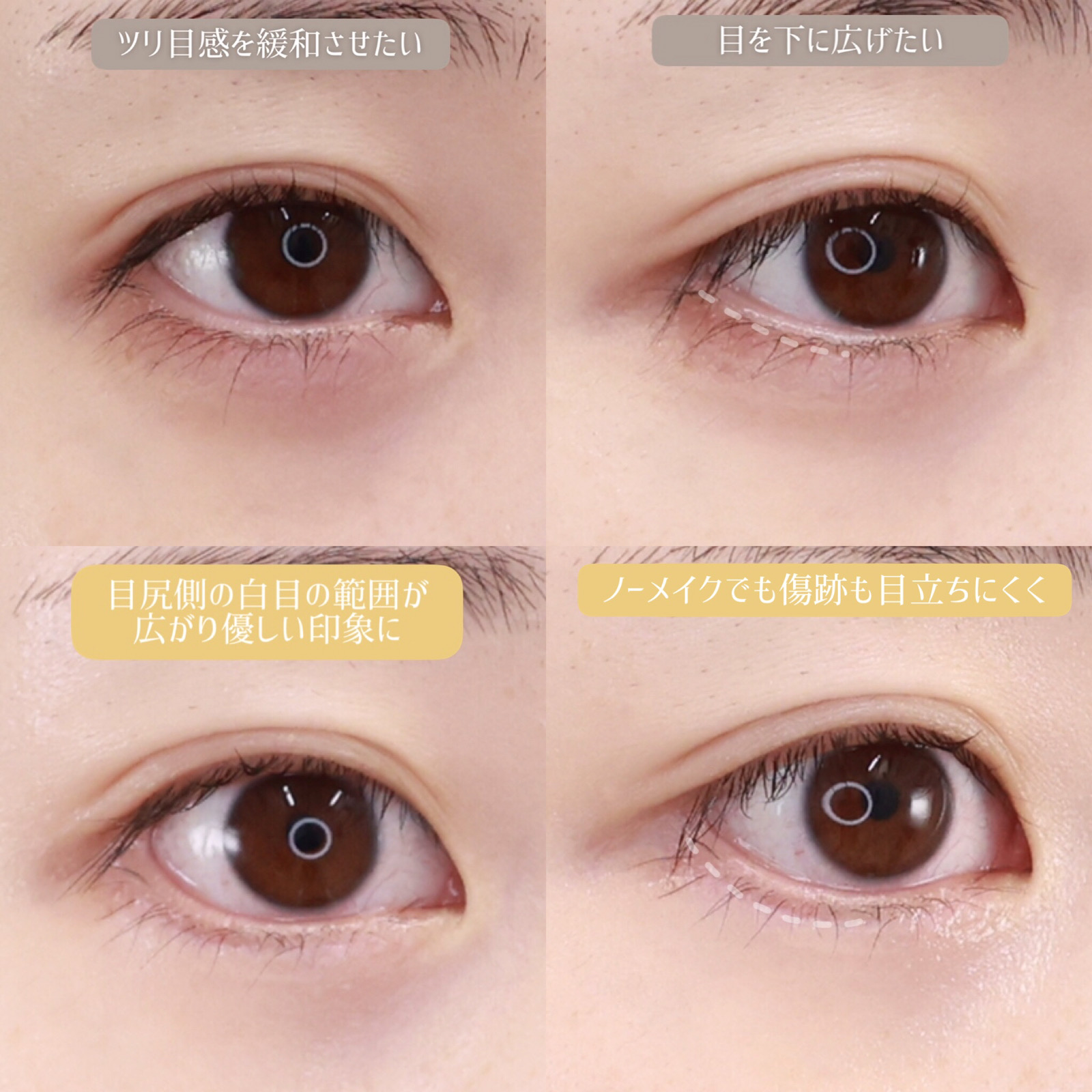 グラマラスライン（タレ目形成）の症例写真 施術前後 