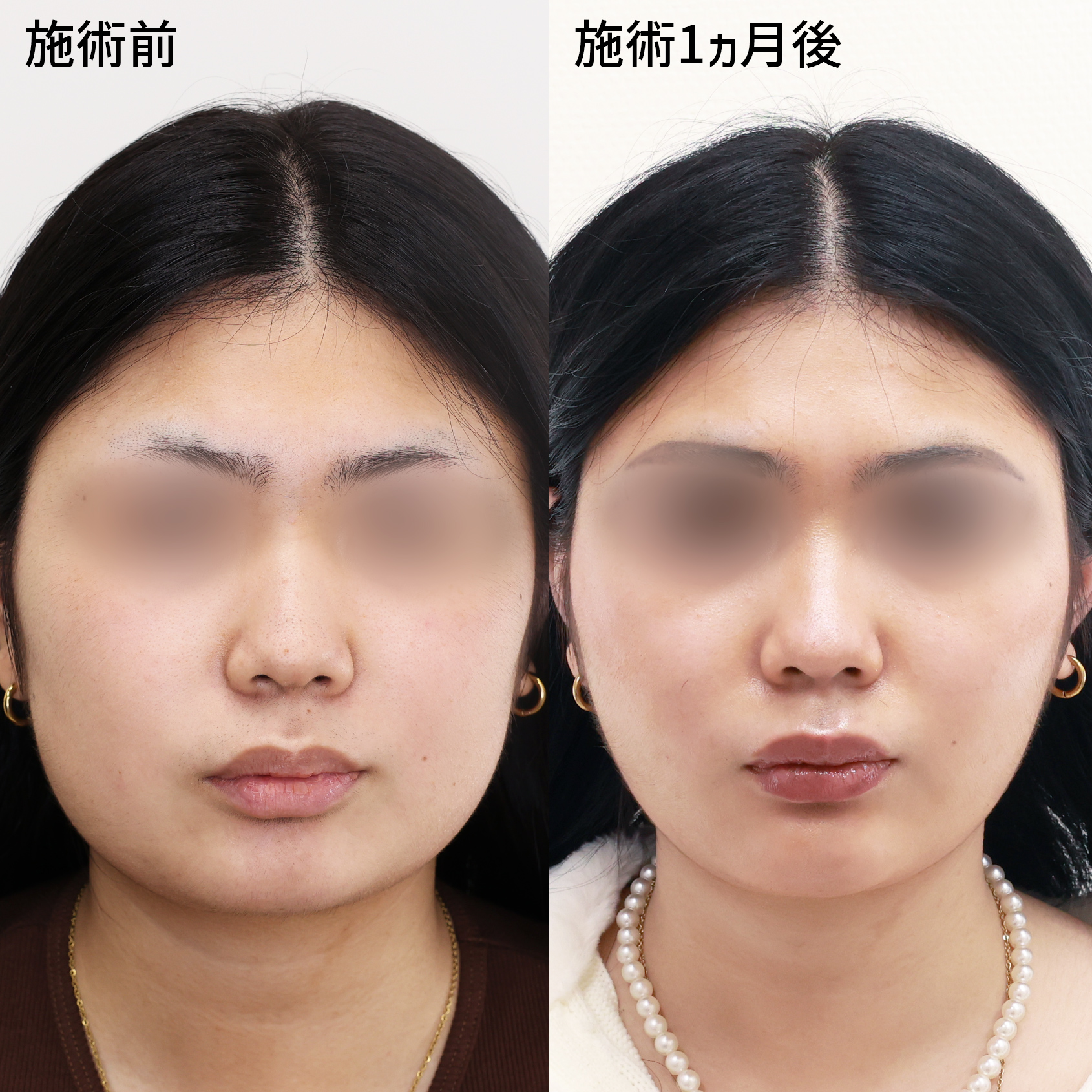 輪郭を変えるオススメセット TAC式ツヤ肌コラーゲンリフト“極”&脂肪除去