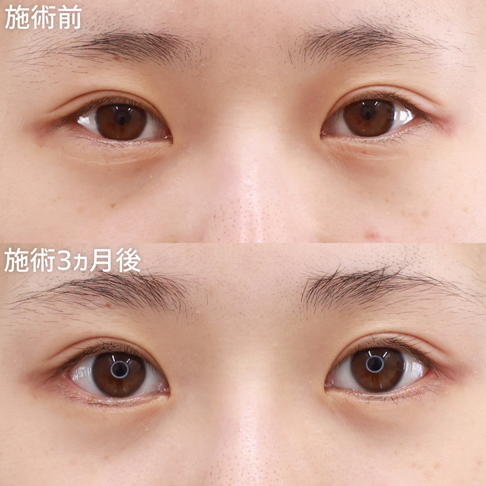 【グラマラスライン&目尻切開&下眼瞼脱脂】目を大きく、丸くかわいく魅せる３施術