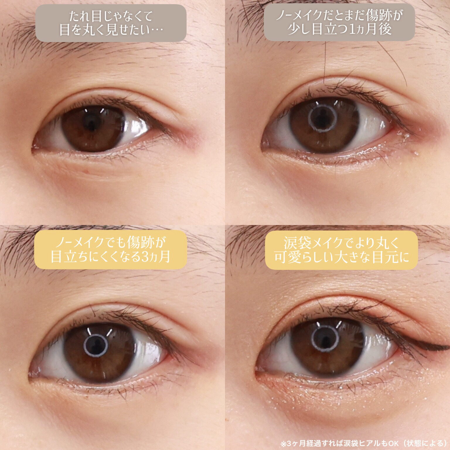 目尻切開術/グラマラスライン（タレ目形成）/下眼瞼脱脂術（目の下のたるみ取り・目の下の脂肪ふくらみ取り）の症例写真 施術前後 