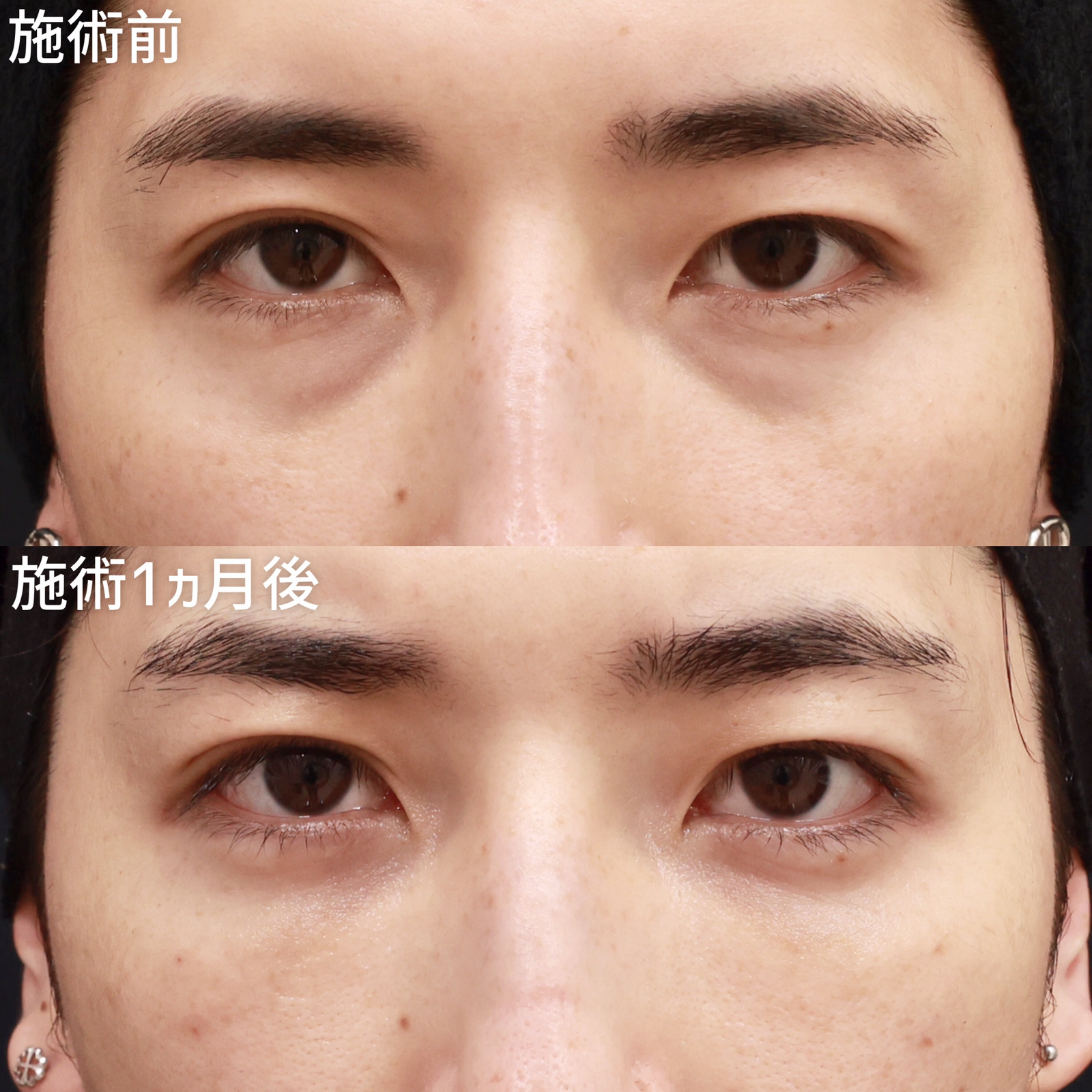 下眼瞼脱脂術（目の下のたるみ取り・目の下の脂肪ふくらみ取り）/顔の脂肪注入(コンデンスリッチフェイス)の症例写真 施術前後 