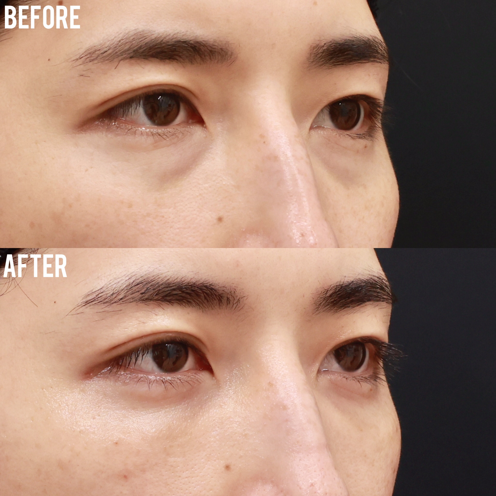 下眼瞼脱脂術（目の下のたるみ取り・目の下の脂肪ふくらみ取り）/顔の脂肪注入(コンデンスリッチフェイス)の症例写真 施術前後 