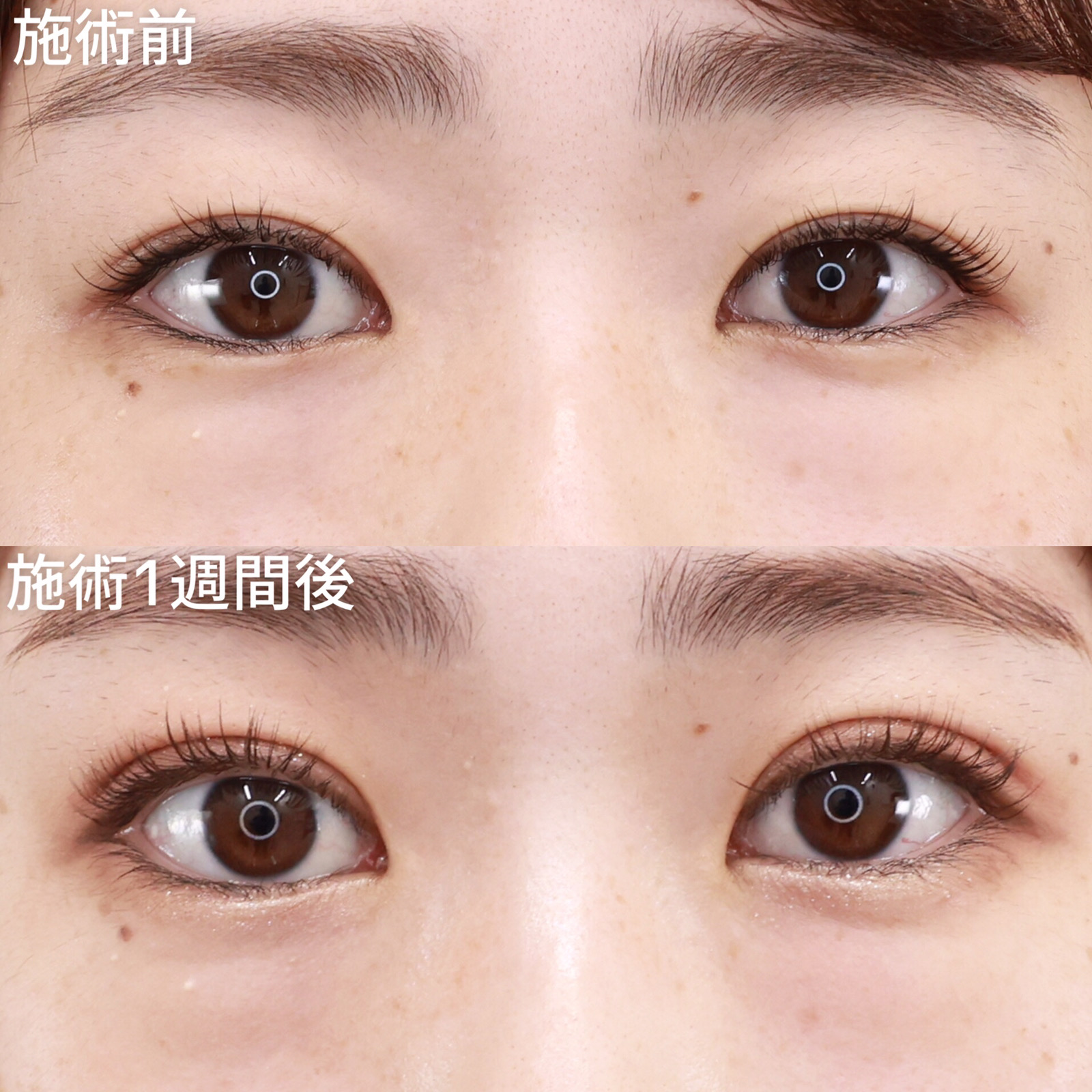 【バレにくい二重埋没法】二重幅を少し広げるだけでも、目元の印象は変わります