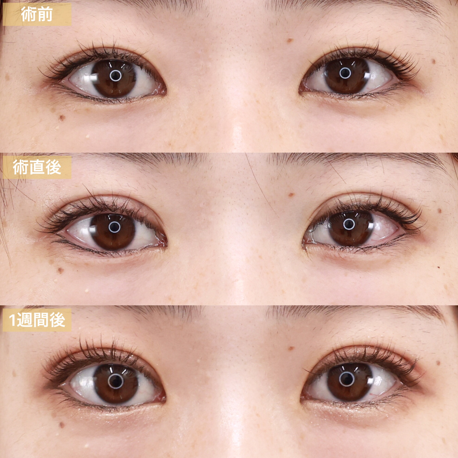 クイックコスメリングの症例写真 施術前後 