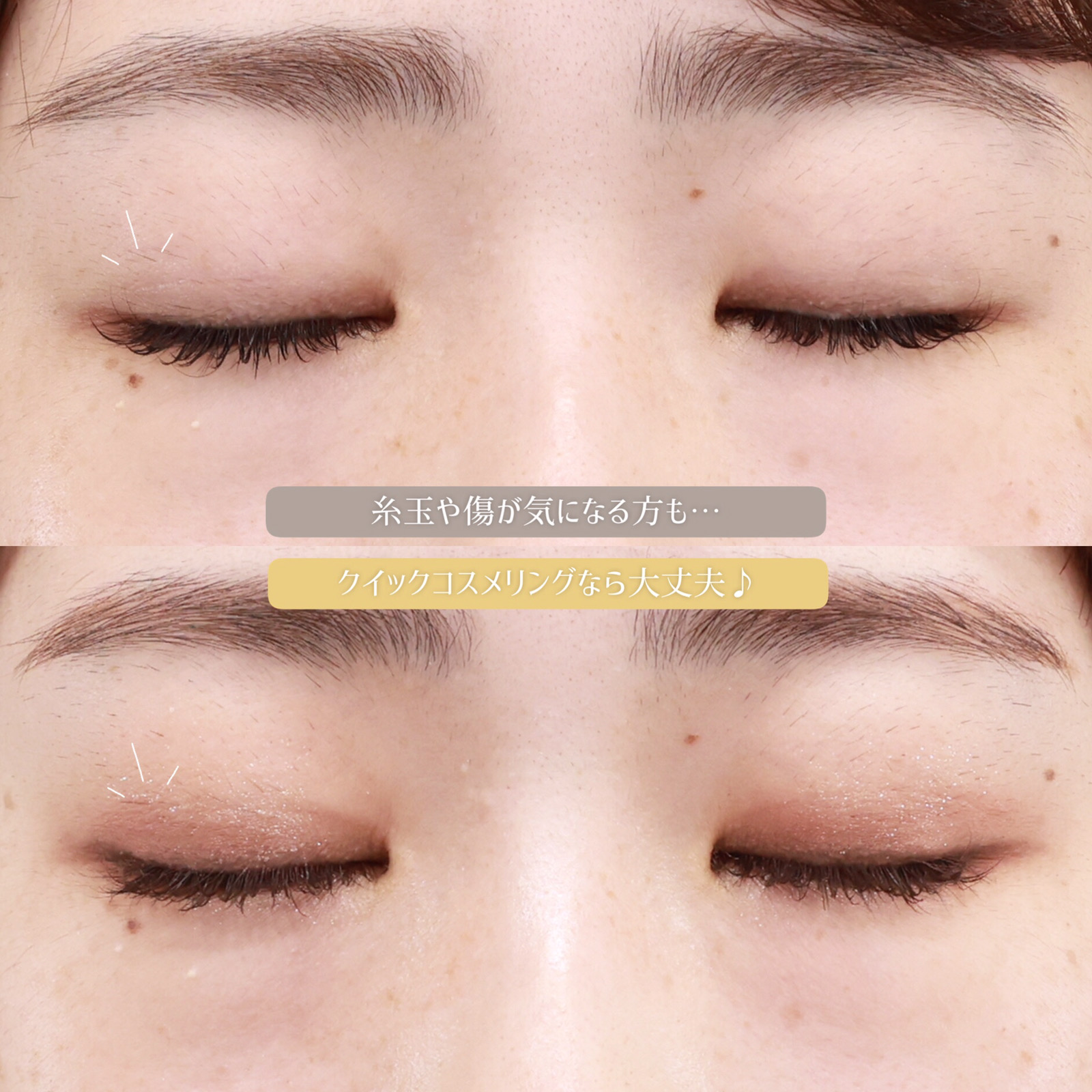 クイックコスメリングの症例写真 施術前後 