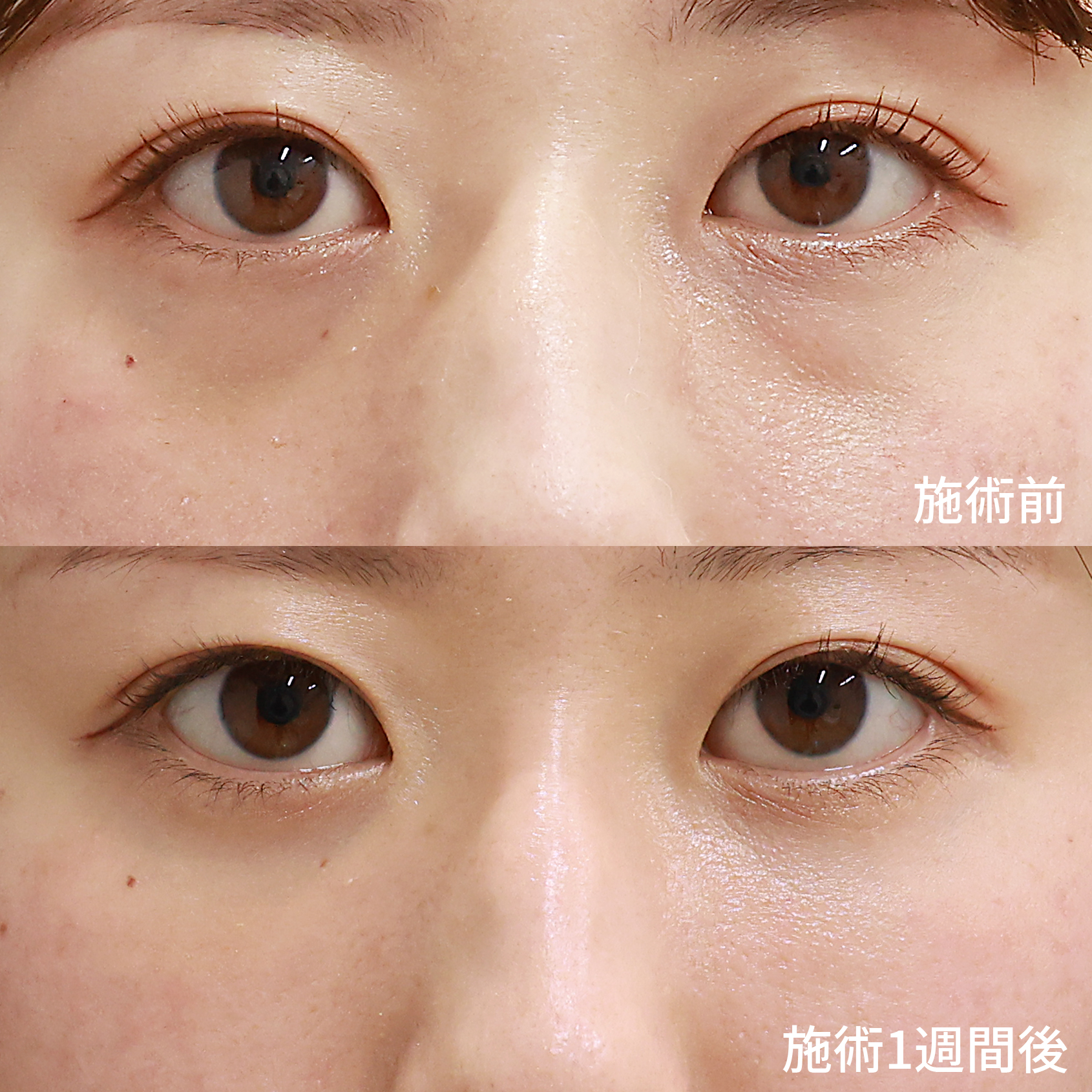 目の下の膨らみが改善したら健康的で若々しい印象に。