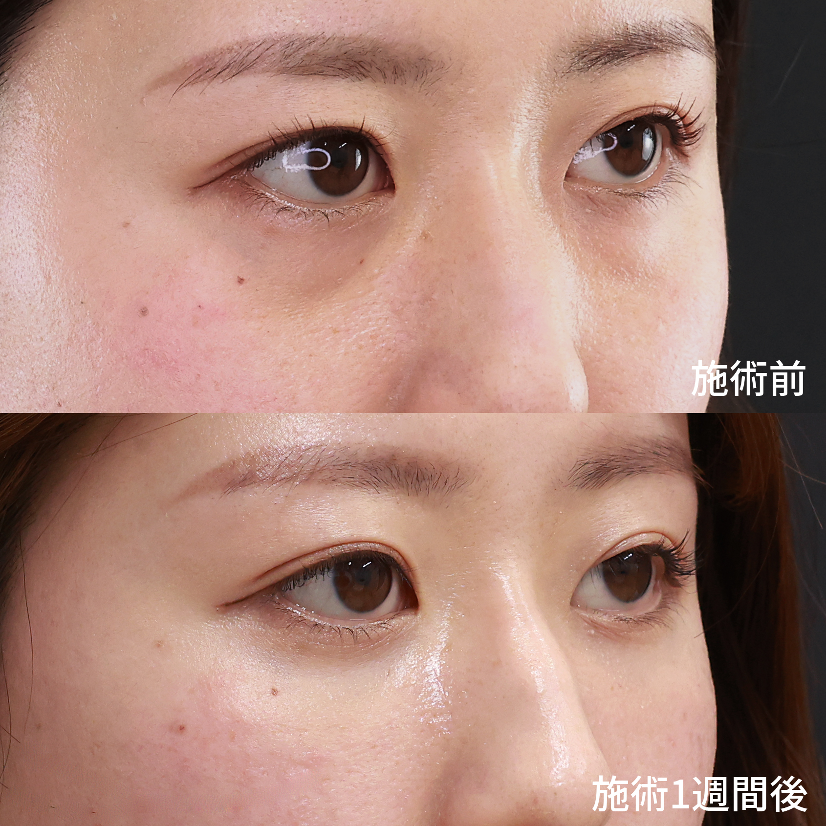 顔の脂肪注入(コンデンスリッチフェイス)/下眼瞼脱脂術（目の下のたるみ取り・目の下の脂肪ふくらみ取り）の症例写真 施術前後 