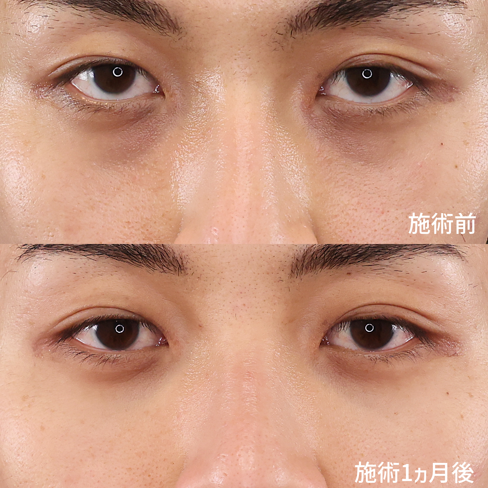 不健康に見られる原因は目の下のクマ。【下眼瞼脱脂術】で若々しい印象に。