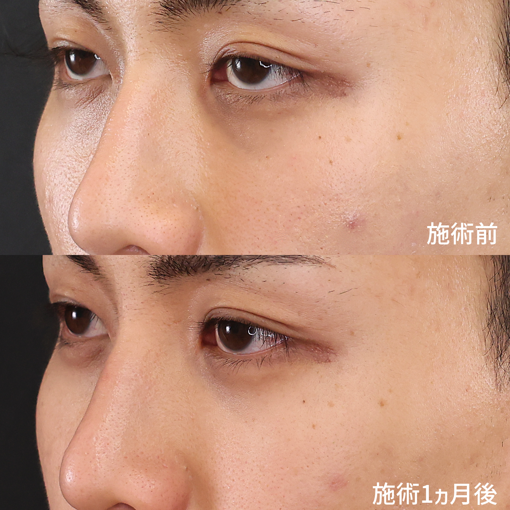 下眼瞼脱脂術（目の下のたるみ取り・目の下の脂肪ふくらみ取り）の症例写真 施術前後 