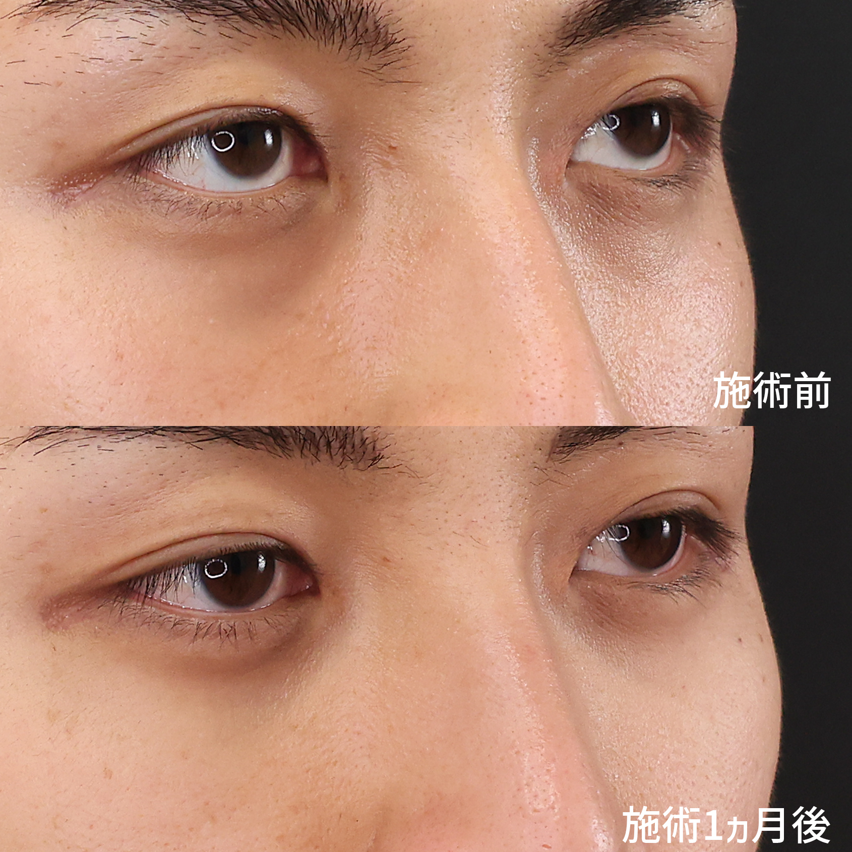 下眼瞼脱脂術（目の下のたるみ取り・目の下の脂肪ふくらみ取り）の症例写真 施術前後 