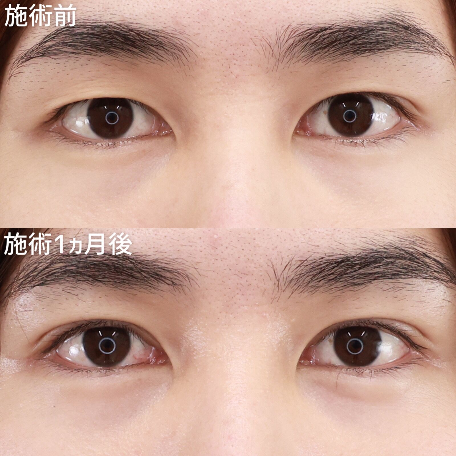 【二重埋没法】目力UPでよりイケメンに！！