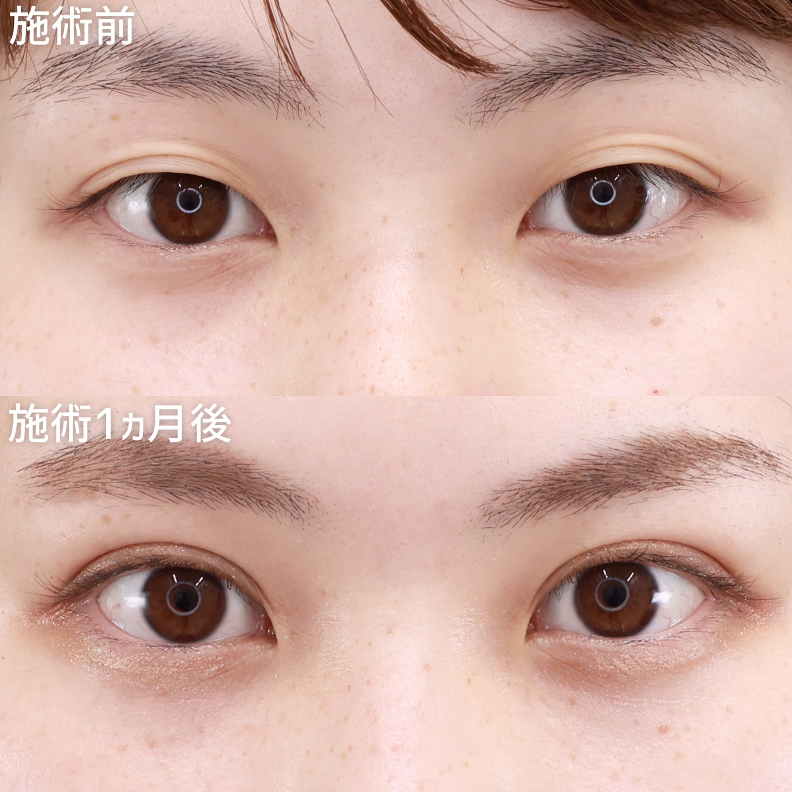 【二重埋没法】毎朝悩まされる不安定な二重のラインもたった数分で解決！