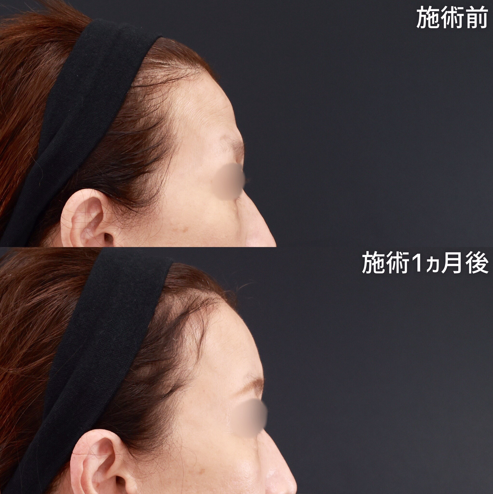 顔の脂肪注入(コンデンスリッチフェイス)/おでこボトックス注射の症例写真 施術前後 