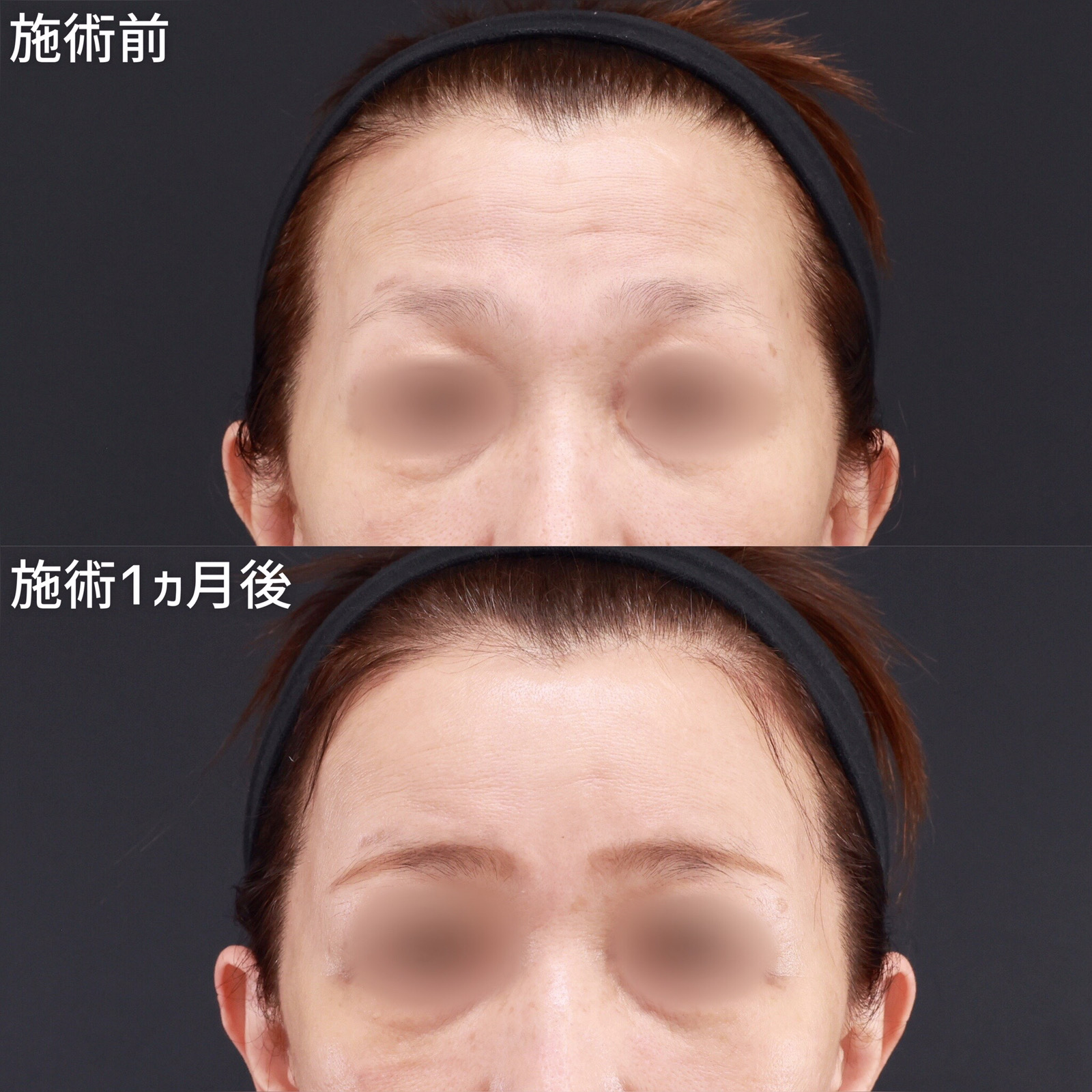 【コンデンスリッチ脂肪注入】骨ばった印象の額に丸みを出す