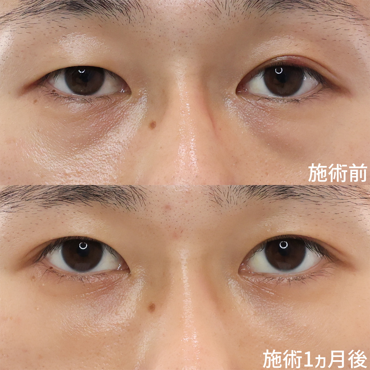 印象をガラッと変える！目元の複合施術