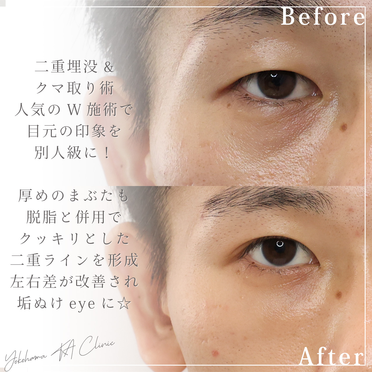 下眼瞼脱脂術（目の下のたるみ取り・目の下の脂肪ふくらみ取り）/顔の脂肪注入(コンデンスリッチフェイス)/二重埋没法の症例写真 施術前後 