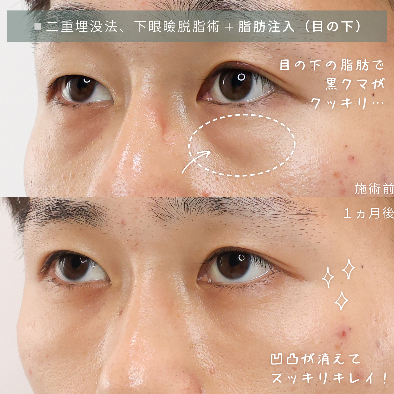 下眼瞼脱脂術（目の下のたるみ取り・目の下の脂肪ふくらみ取り）/顔の脂肪注入(コンデンスリッチフェイス)/二重埋没法の症例写真 施術前後 