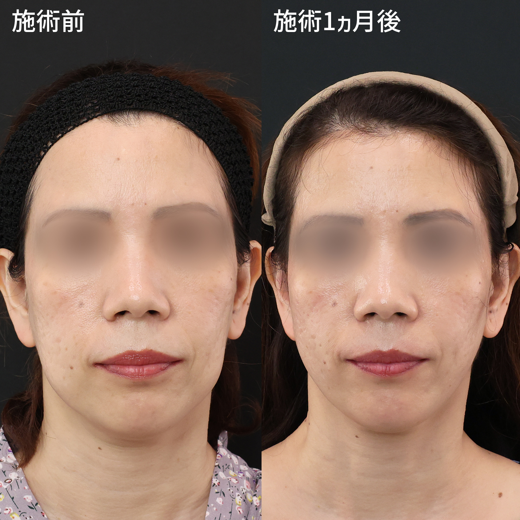 ボコつきの原因となる脂肪を除去！滑らかなフェイスラインに