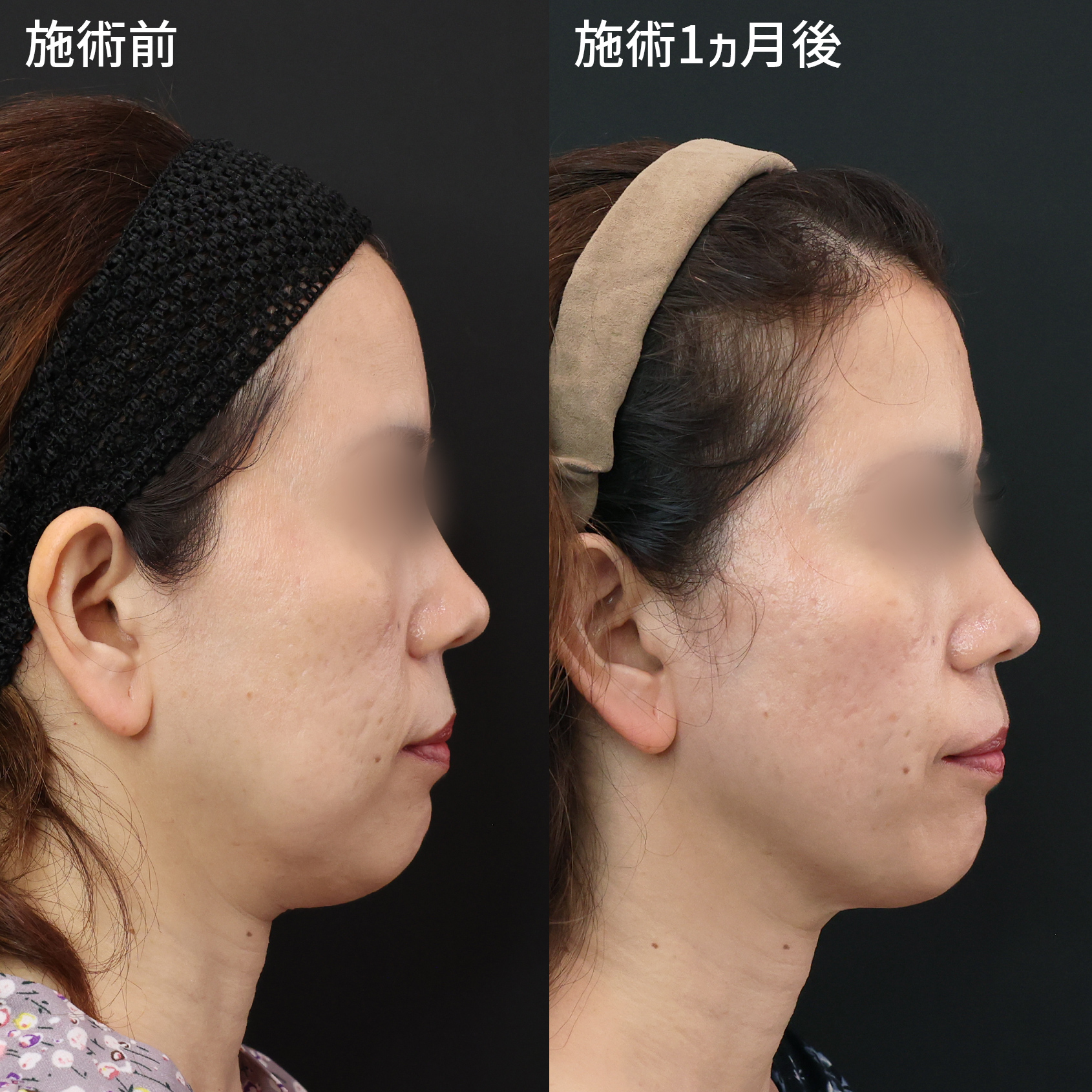 バッカルファット除去/ジョールファット除去/TAC式 ツヤ肌コラーゲンリフト®の症例写真 施術前後 
