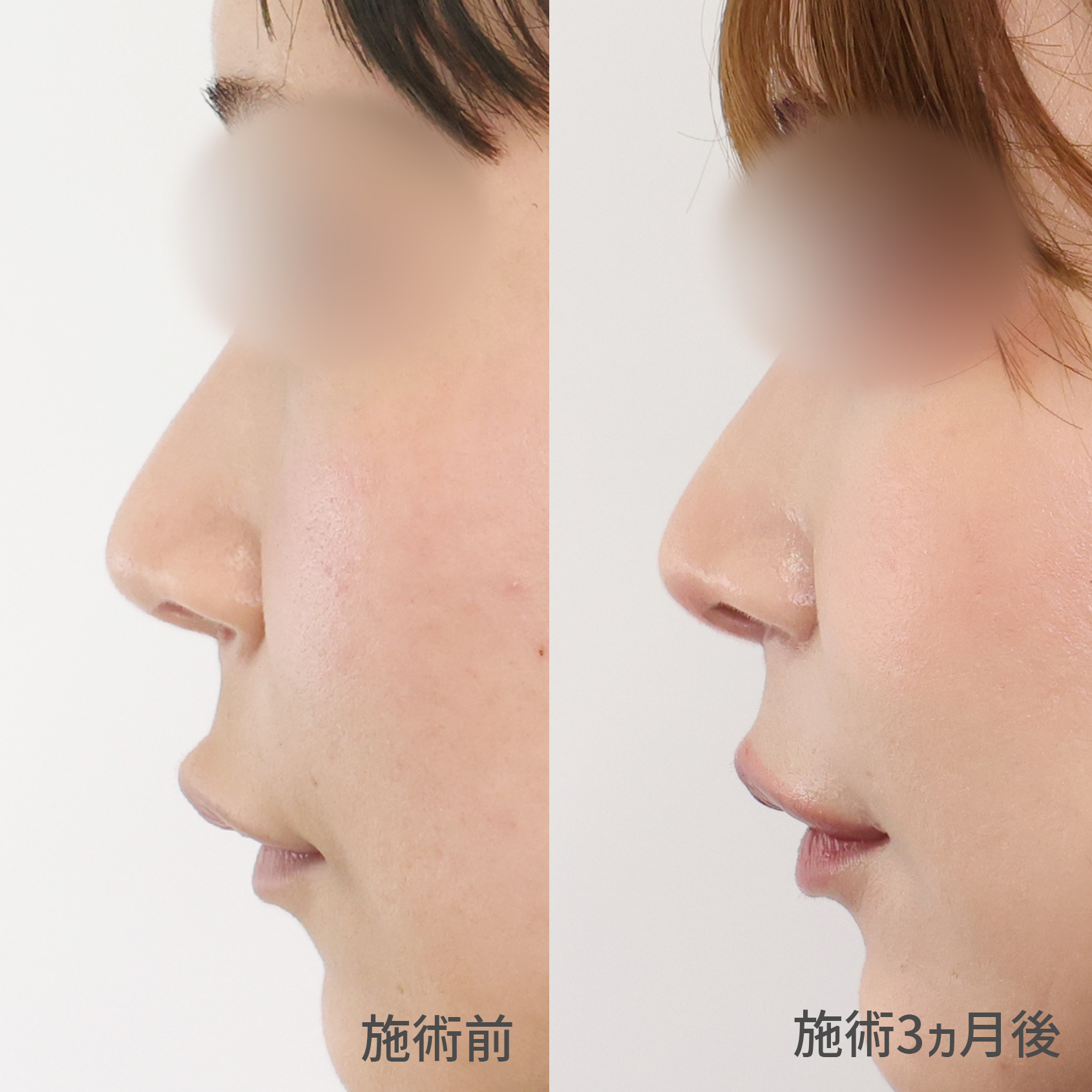 人中短縮術(リップリフト)・外側人中短縮術/口角挙上・リフト（マイクロ切開法・内側法/口内法）の症例写真 施術前後 