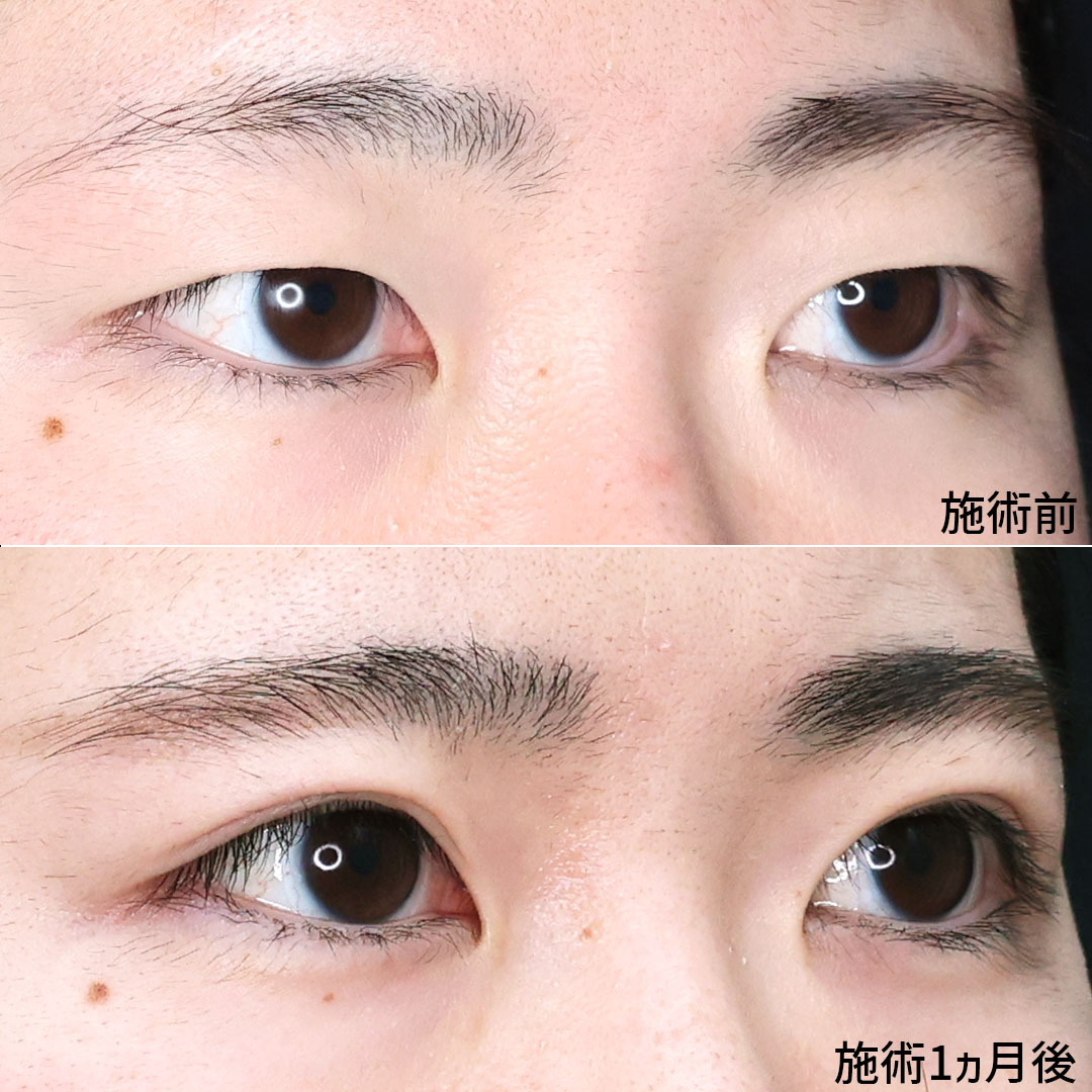 二重埋没法の症例写真 施術前後 