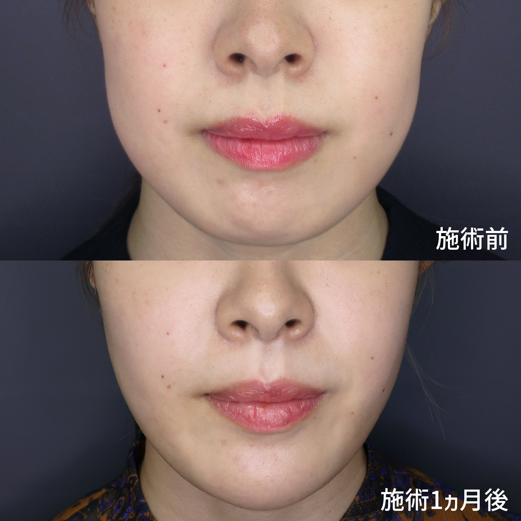 20代から始めるフェイスケアで別人級の小顔へ