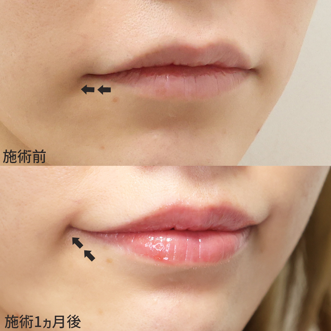 口角挙上・リフト(マイクロ切開法・内側法/口内法)/ボトックス注射:その他の症例写真 施術前後