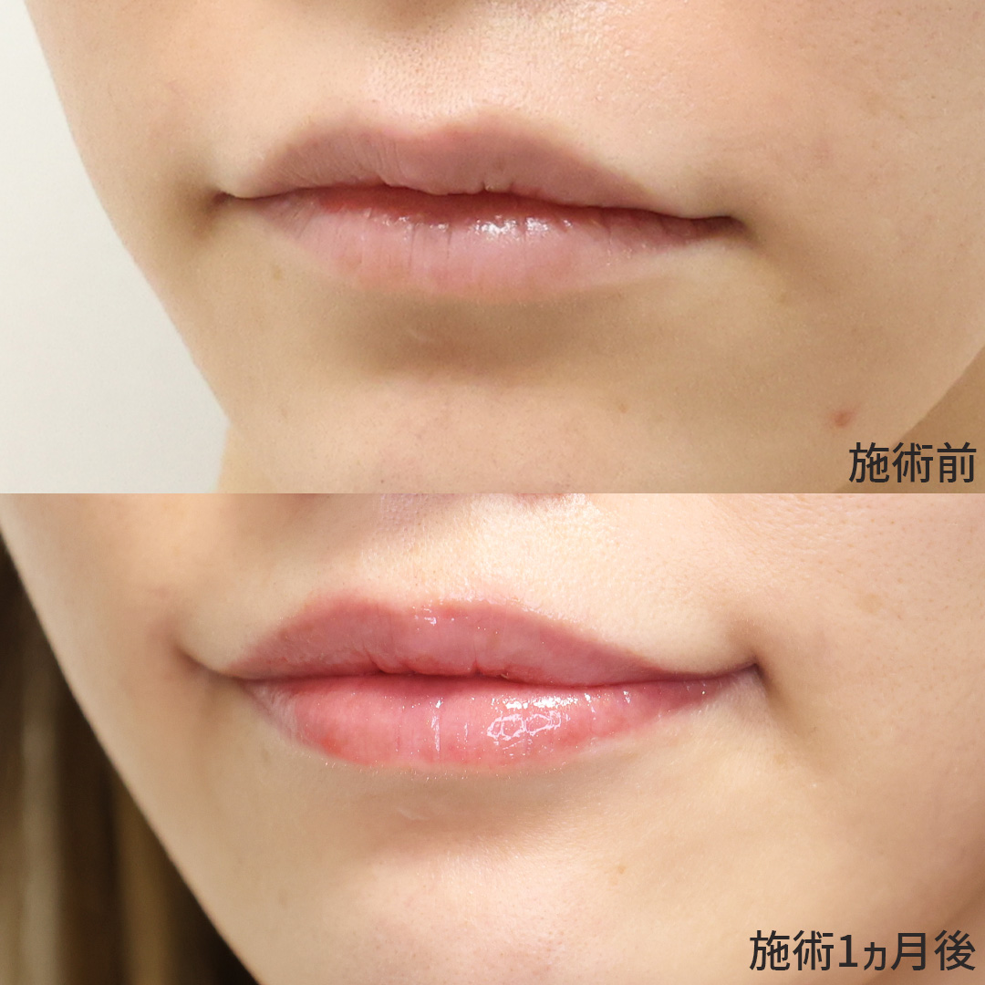 口角挙上・リフト(マイクロ切開法・内側法/口内法)/ボトックス注射:その他の症例写真 施術前後