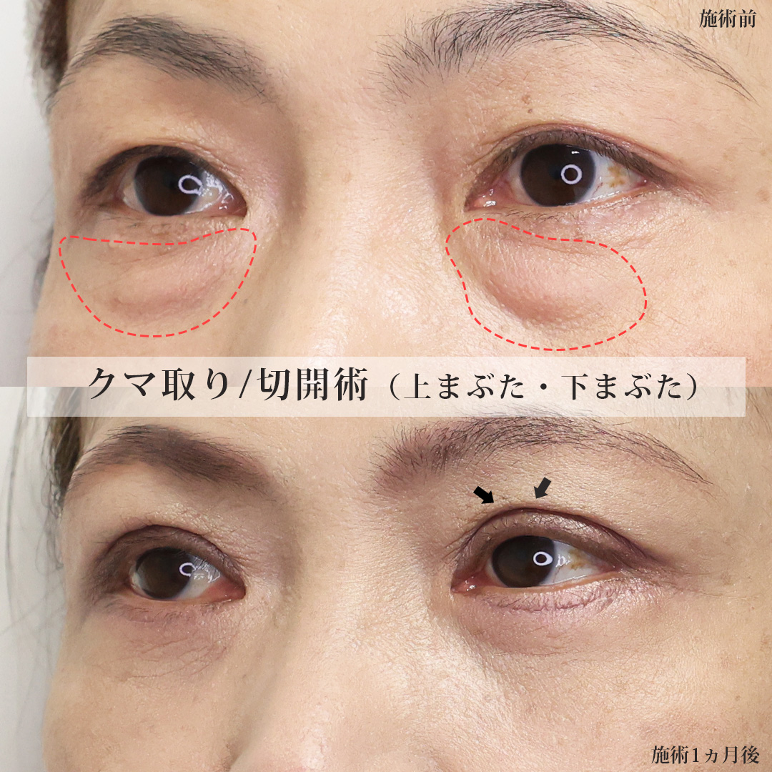 上眼瞼切開術/下眼瞼切開術（クマ・たるみとり）/下眼瞼脱脂術（目の下のたるみ取り・目の下の脂肪ふくらみ取り）の症例写真 施術前後 