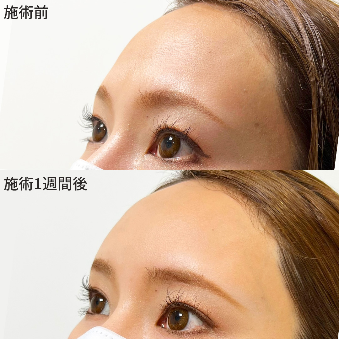 【ヒアルロン酸注入】おでこ美人になりたい方へ