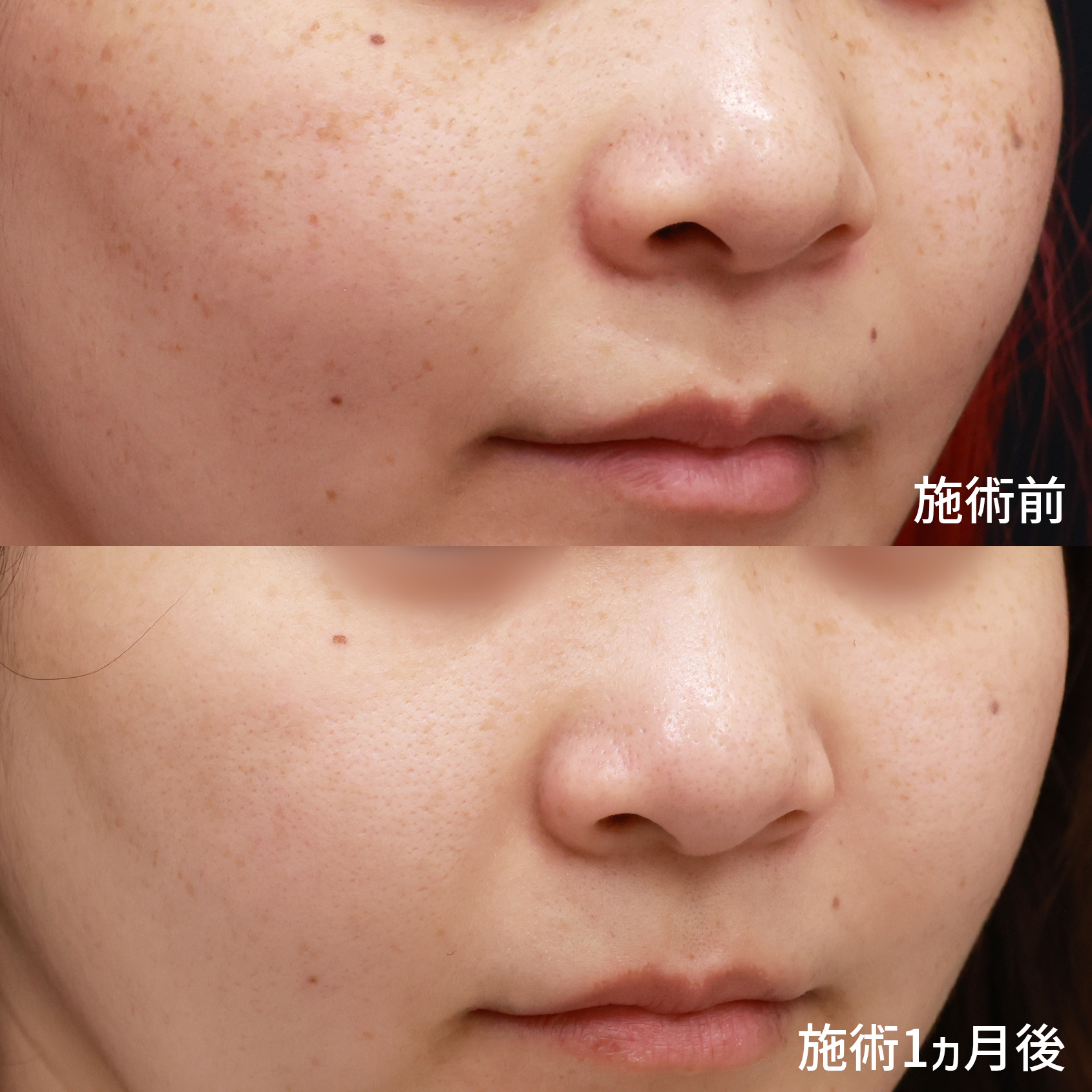 フォトシルクプラス光治療の症例写真 施術前後 