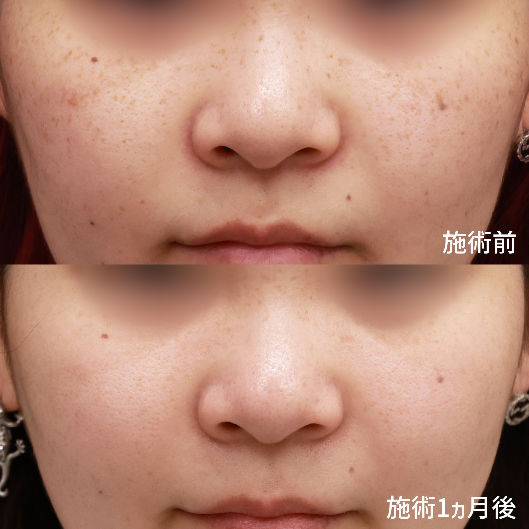 フォトシルクプラス光治療の症例写真 施術前後 