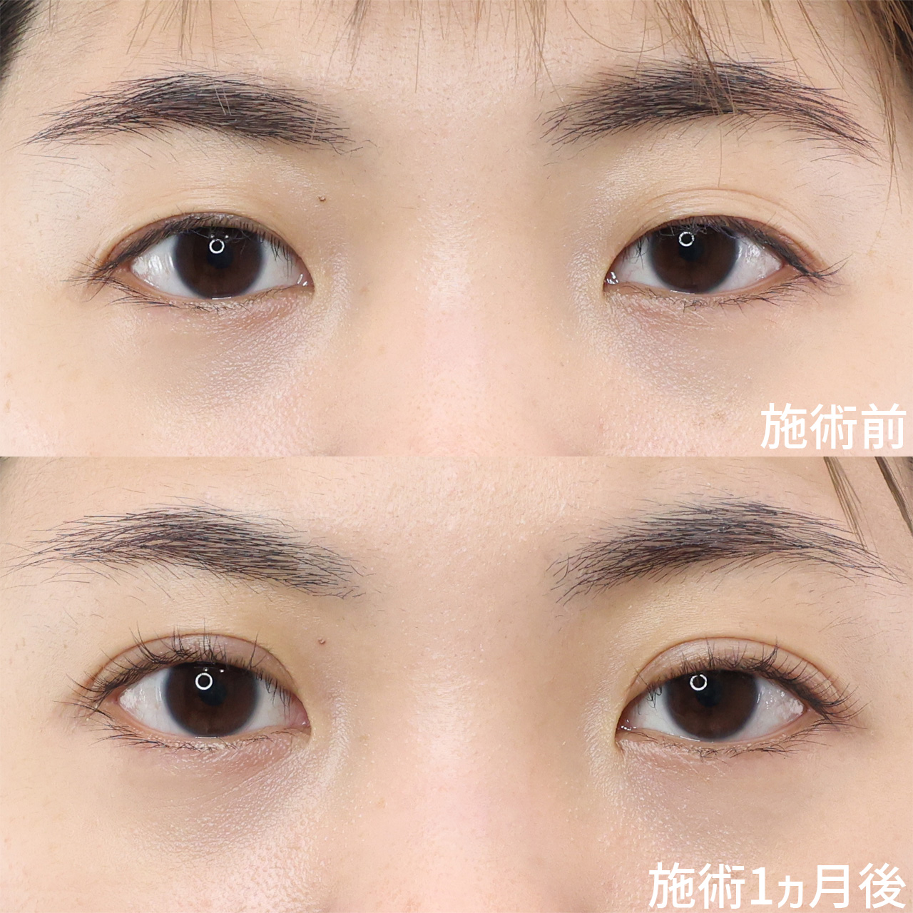 二重埋没法の症例写真 施術前後