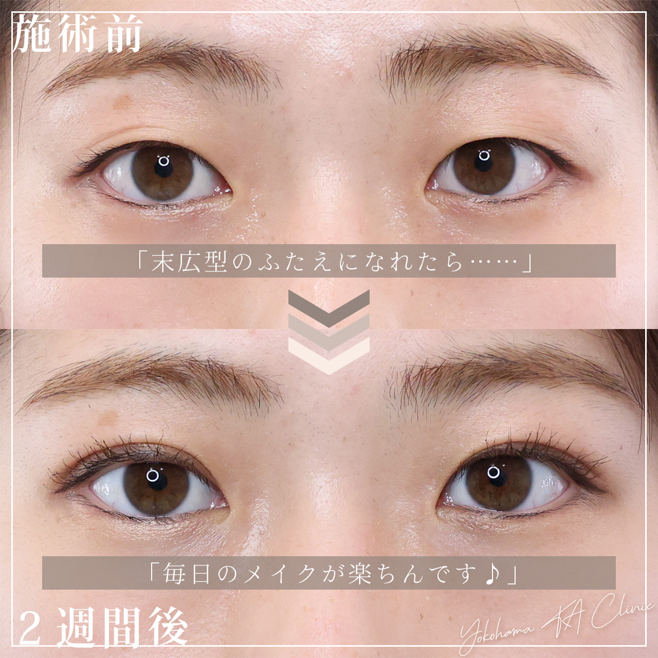 二重埋没法の症例写真 施術前後 