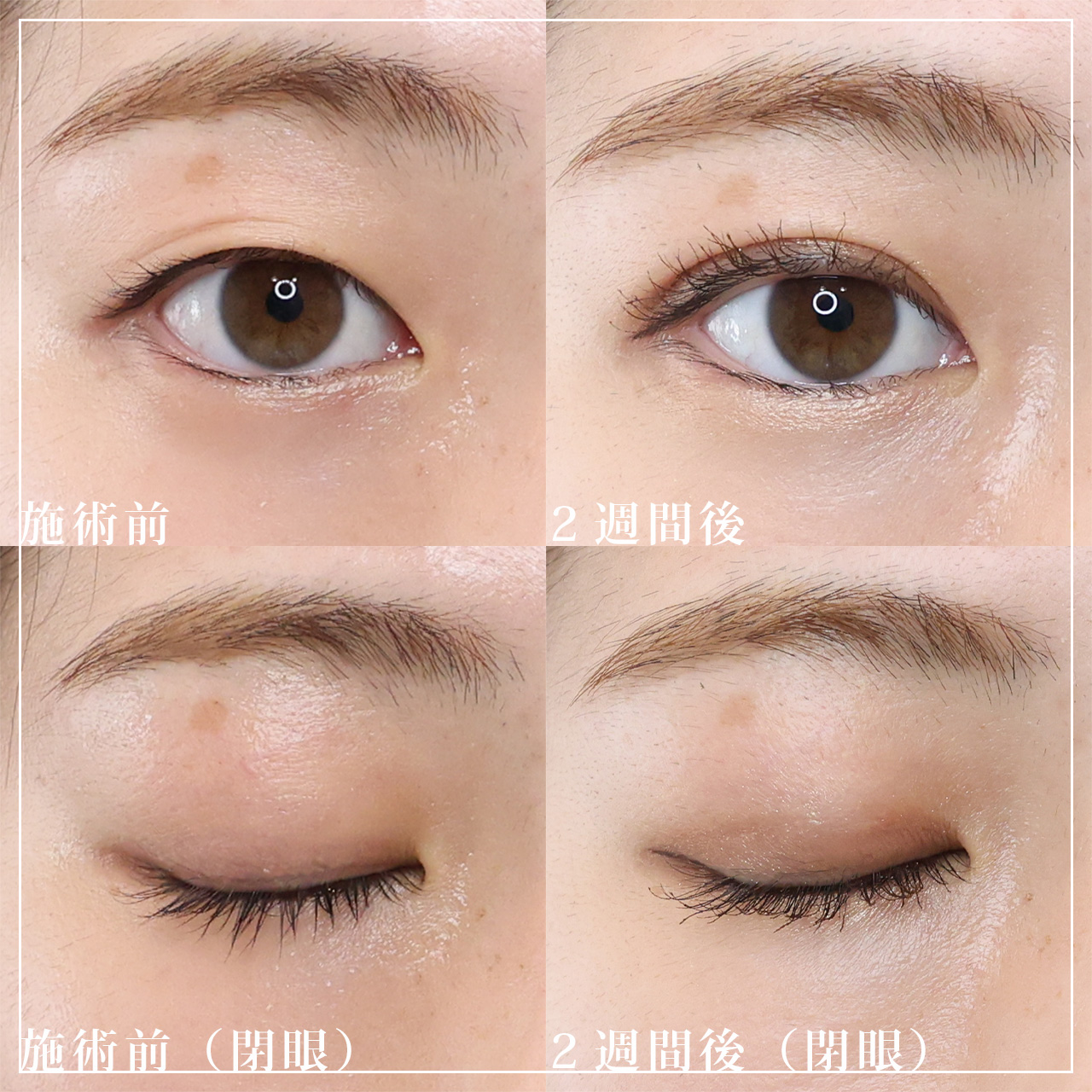 二重埋没法の症例写真 施術前後 