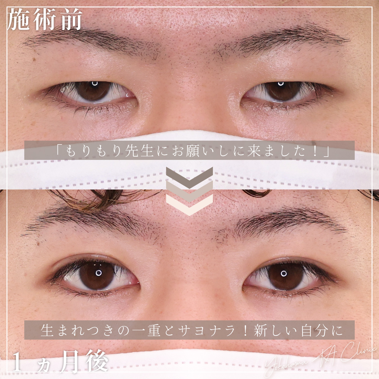 二重切開（全切開法）の症例写真 施術前後 