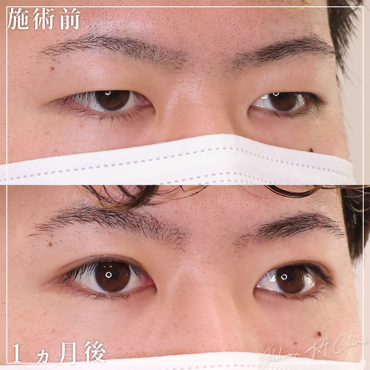 二重切開（全切開法）の症例写真 施術前後 